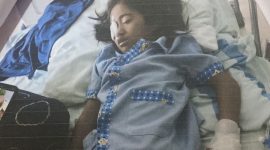 Alesha, Anak 7 Tahun Asal Karimun yang Berjuang Melawan Kanker Otak. Foto: Istimewa